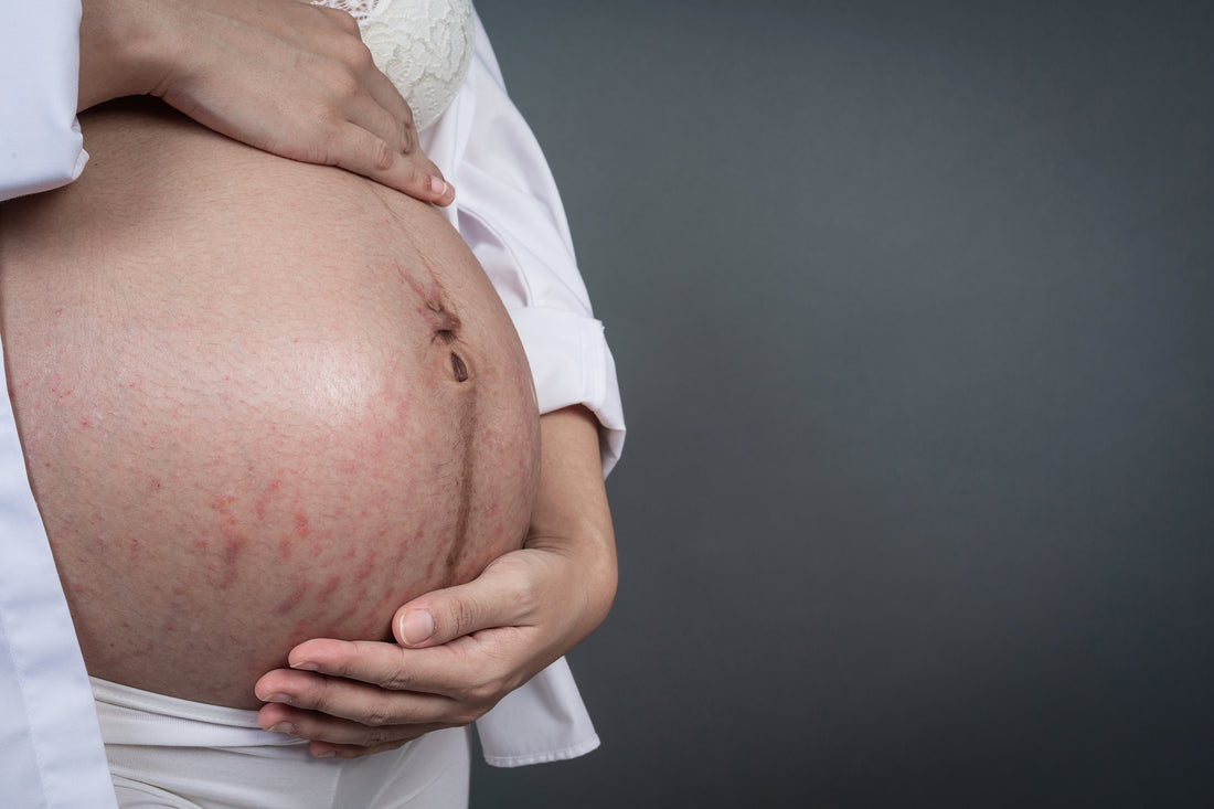 Pourquoi les vergetures apparaissent pendant la grossesse ?